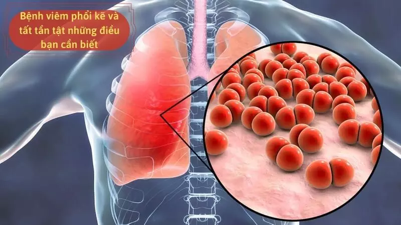 Bệnh viêm phổi kẽ và tất tần tật những điều bạn cần biết 